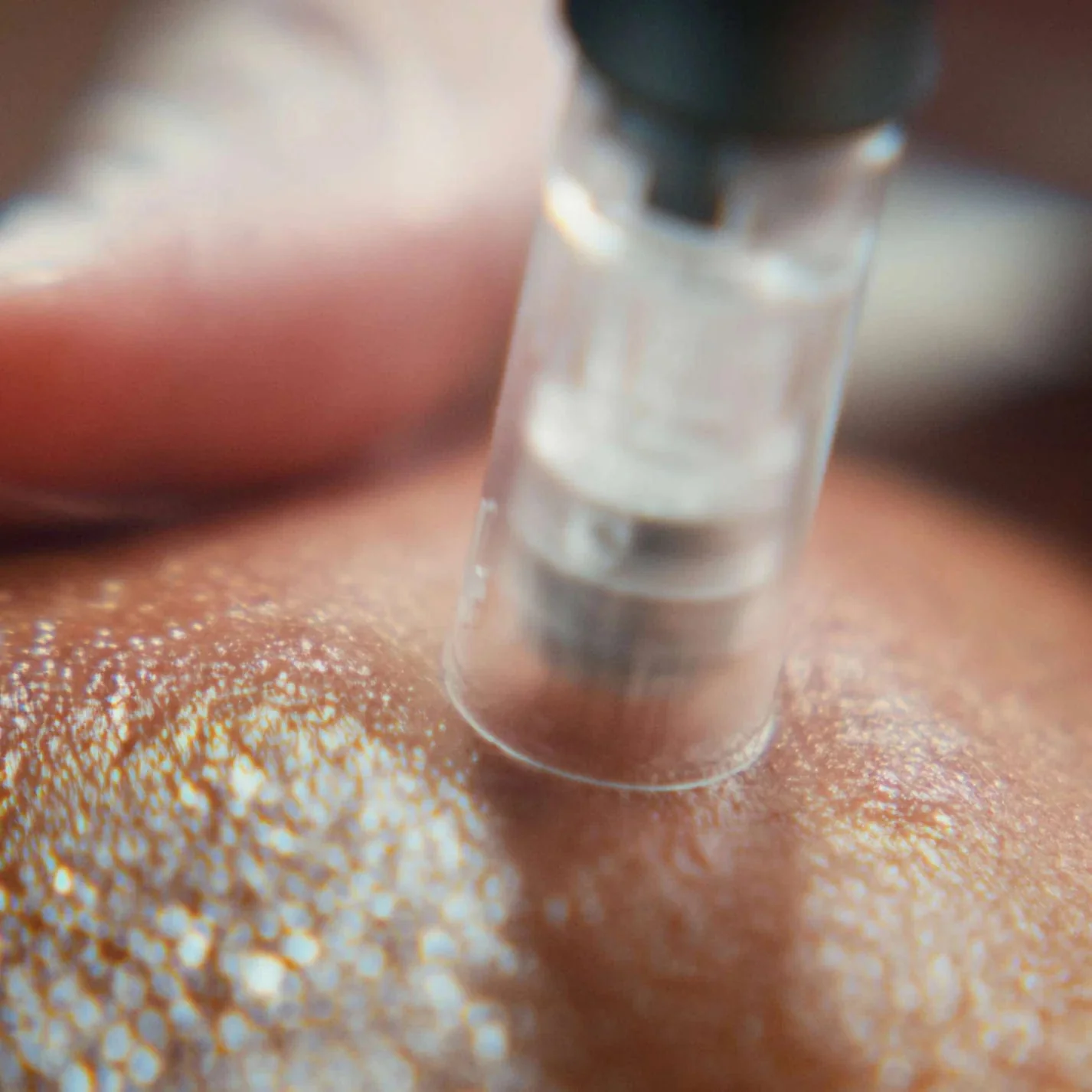 Alternative view of Pro Microneedling