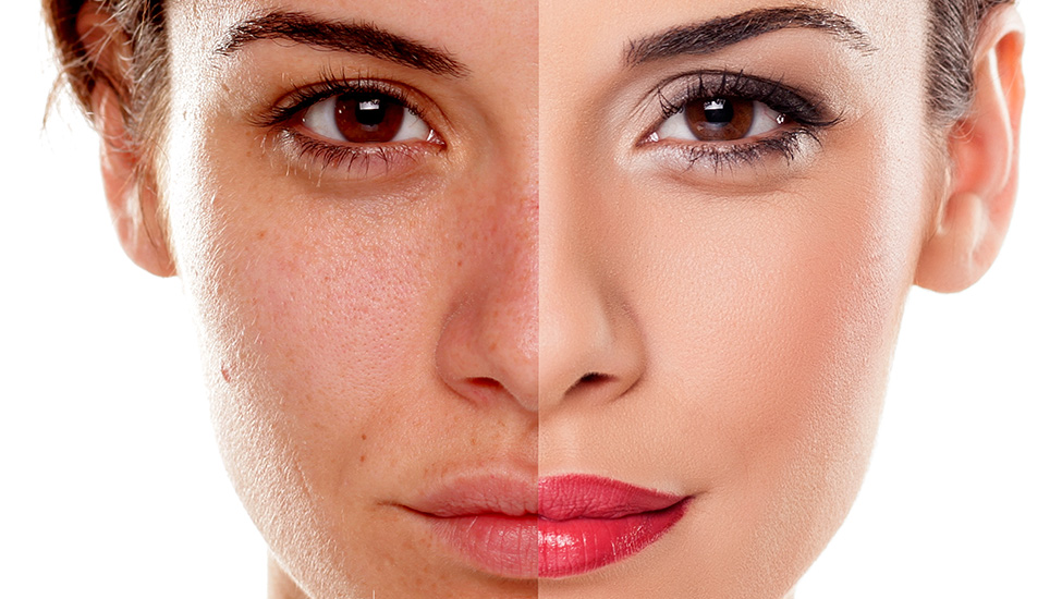 Phục hồi da thâm sạm